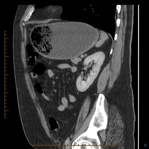 File:Bariatric balloon causing gastric outlet obstruction (Radiopaedia 54449-60672 C 25).jpg