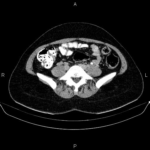 File:Bartholin gland cyst (Radiopaedia 62635-70930 C 6).jpg