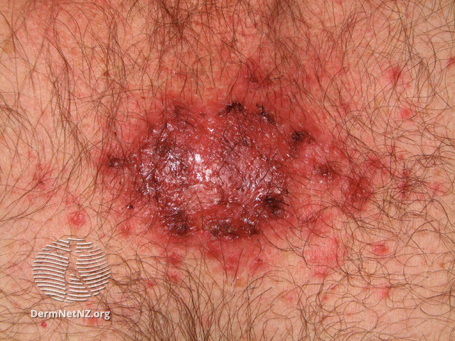 File:Basal cell carcinoma affecting the trunk (DermNet NZ lesions-bcc-trunk-0708).jpg