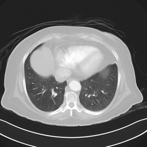 Basal ganglia metastasis (Radiopaedia 78928-91832 B 35).png