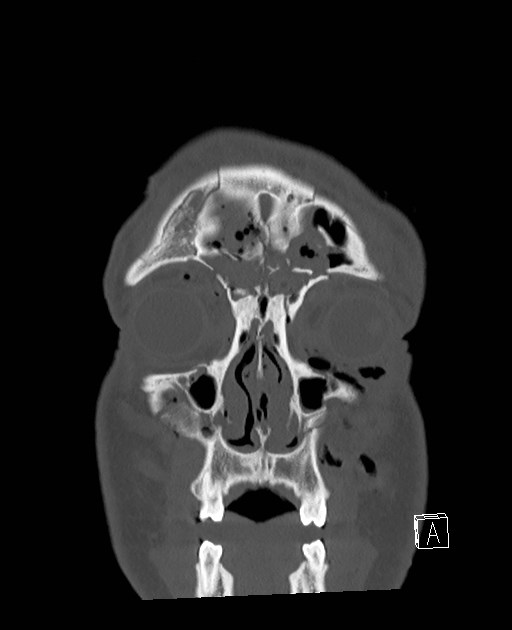 Base of skull fracture with bilateral Le Fort fractures (Radiopaedia 47094-51638 Coronal bone window 84).jpg