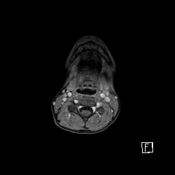 Base of skull rhabdomyosarcoma (Radiopaedia 32196-33142 T1 C+ fat sat 2).jpg