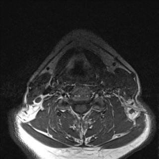 File:Base of tongue squamous cell carcinoma (Radiopaedia 31174-31884 Axial T1 7).jpg