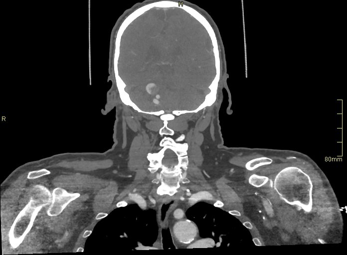 Basilar artery aneurysm (Radiopaedia 56261-62932 B 45).jpg