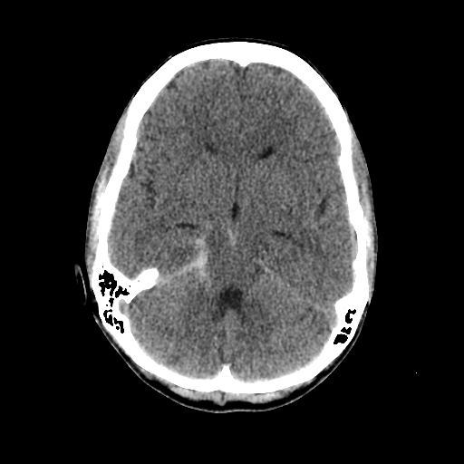 File:Basilar artery perforator aneurysm (Radiopaedia 82455-96597 Axial non-contrast 14).jpg