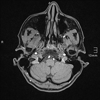 Basilar artery perforator aneurysm (Radiopaedia 82455-99523 F 8).jpg