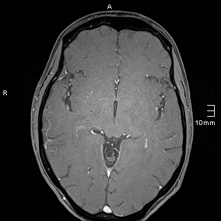 File:Basilar artery perforator aneurysm (Radiopaedia 82455-99523 G 72).jpg
