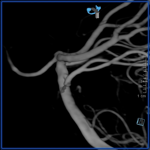 Basilar artery perforator aneurysm (Radiopaedia 82455-99524 3D Left VA 23).jpg