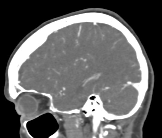 Basilar tip aneurysm with coiling (Radiopaedia 53912-60086 C 33).jpg