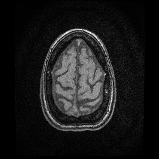 Basilar top and left middle cerebral artery aneurysm (Radiopaedia 61965-70031 Axial MRA 158).jpg