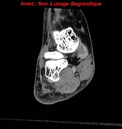 Baxter neuropathy (Radiopaedia 25988-26125 Coronal non-contrast 7).jpg