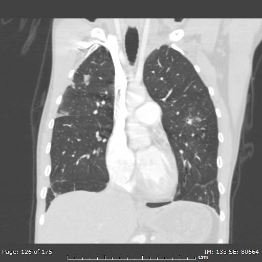 Behçet disease (Radiopaedia 44247-47889 Coronal lung window 39).jpg