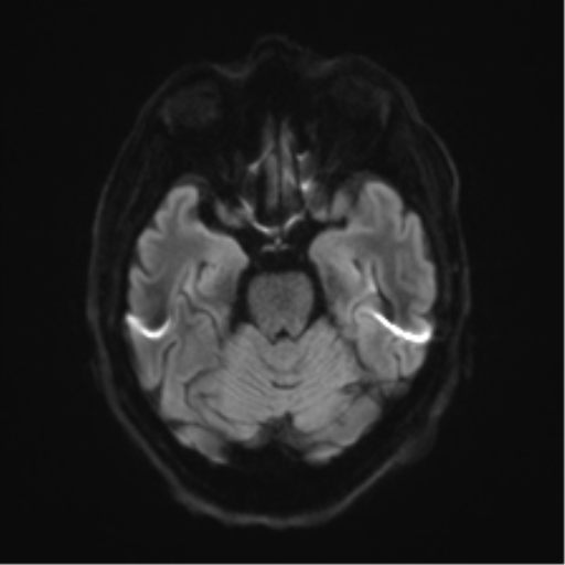 Behavioral variant frontotemporal dementia and late onset schizophrenia (Radiopaedia 52197-58083 Axial DTI Trace W 36).png