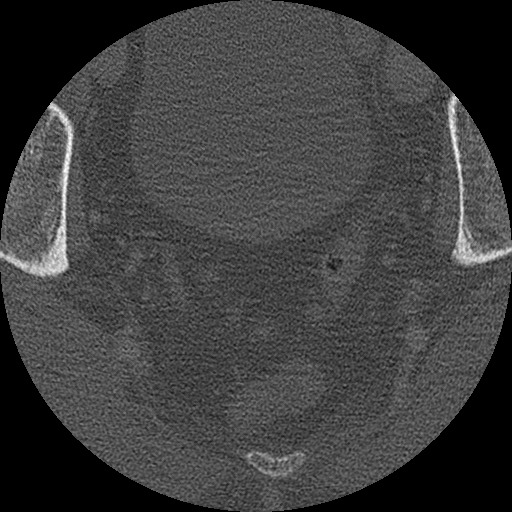 Benign post-traumatic pseudopneumoperitoneum (Radiopaedia 71199-81495 Axial bone window 318).jpg