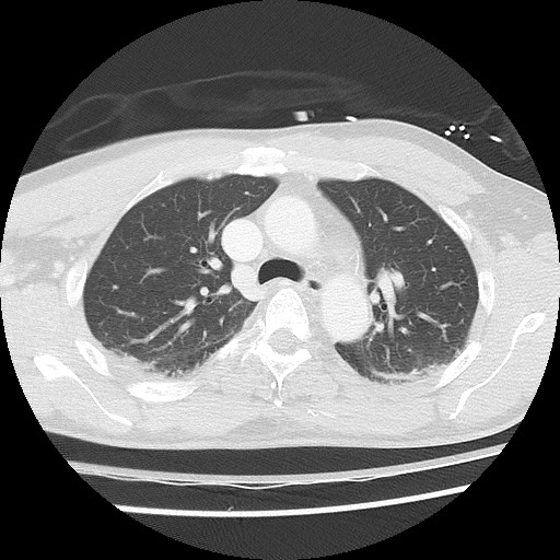 Benign post-traumatic pseudopneumoperitoneum (Radiopaedia 71199-81495 Axial lung window 29).jpg