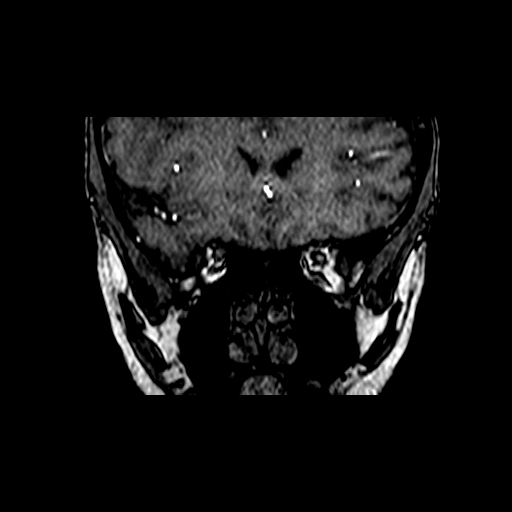 Berry aneurysm of the terminal internal carotid artery (Radiopaedia 88286-104918 Coronal TOF 17).jpg