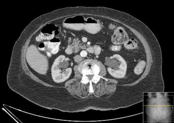 Bicameral celiacomesenteric aneurysm (Radiopaedia 55766-62327 A 29).jpg