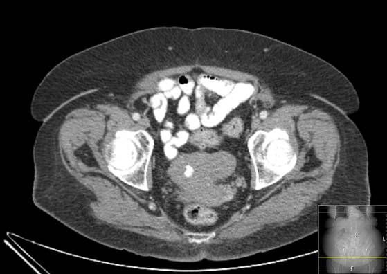 Bicameral celiacomesenteric aneurysm (Radiopaedia 55766-62327 A 65).jpg