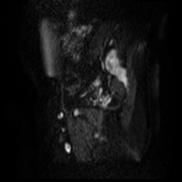 File:Bicornuate uterus (Radiopaedia 51676-57472 Sagittal DWI 20).jpg