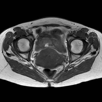 File:Bicornuate uterus (Radiopaedia 61974-70046 Axial T1 33).jpg
