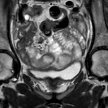 File:Bicornuate uterus (Radiopaedia 61974-70046 Coronal T2 6).jpg