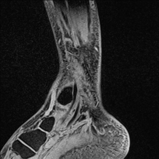 Bilateral Achilles tendon complete tear (Radiopaedia 81344-95051 Sagittal WE - Left 32).jpg