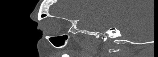 Bilateral Ectopic Infraorbital Nerves (Radiopaedia 49006-54084 Sagittal bone window 8).jpg