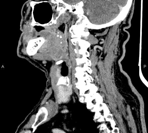 Bilateral Warthin tumors (Radiopaedia 84034-99263 D 35).jpg