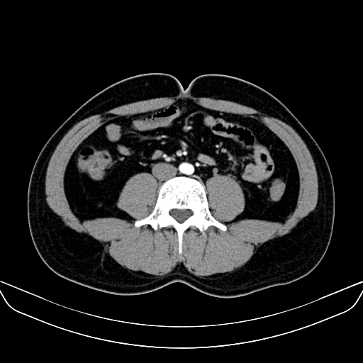 Bilateral accessory renal arteries with mild pelvi-ureteric junction (PUJ) obstruction (Radiopaedia 66357-75596 A 37).jpg