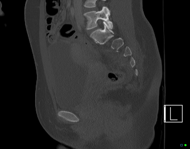 File:Bilateral acetabular fractures (Radiopaedia 79272-92308 Sagittal bone window 41).jpg