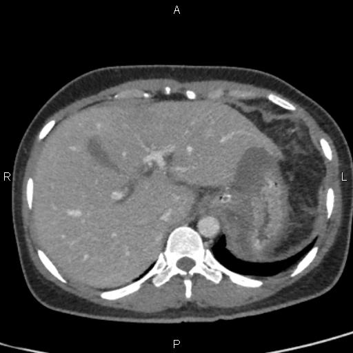 Bilateral adrenal gland hyperenhancement in pancreatitis (Radiopaedia 86642-102753 E 18).jpg