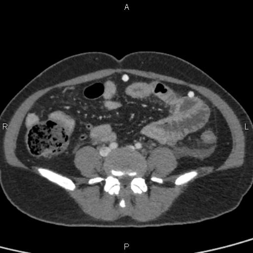 Bilateral adrenal gland hyperenhancement in pancreatitis (Radiopaedia 86642-102753 E 75).jpg