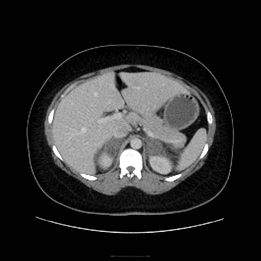 Bilateral adrenal thrombosis (Radiopaedia 58182-65256 A 18).jpg