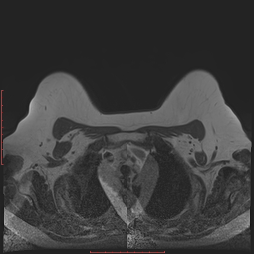 File:Bilateral breast implant rupture (Radiopaedia 24761-25027 T1 5).jpg
