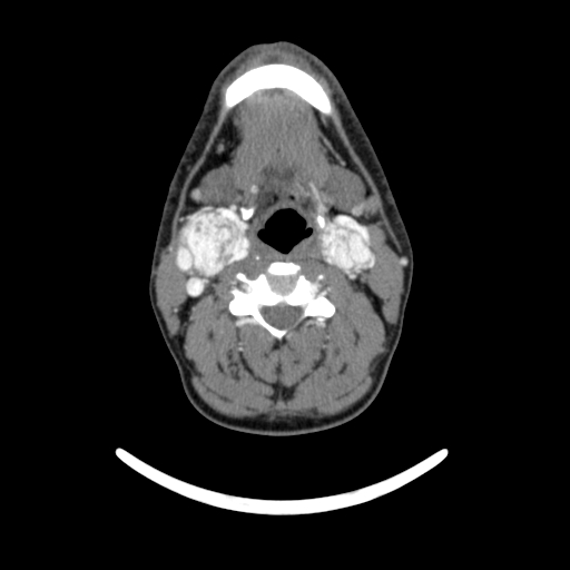 Bilateral carotid body tumors (Radiopaedia 52899-58827 A 8).jpg