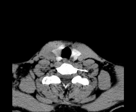 Bilateral carotid body tumors (Radiopaedia 61841-69870 Axial non-contrast 91).jpg