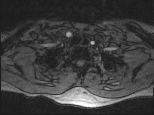 Bilateral carotid body tumors and right glomus jugulare tumor (Radiopaedia 20024-20060 Axial MRA 185).jpg