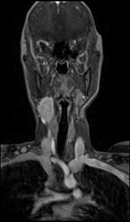 File:Bilateral carotid body tumors and right glomus jugulare tumor (Radiopaedia 20024-20060 MRA 15).jpg