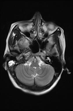 File:Bilateral carotid body tumors and right jugular paraganglioma (Radiopaedia 20024-20060 Axial 59).jpg