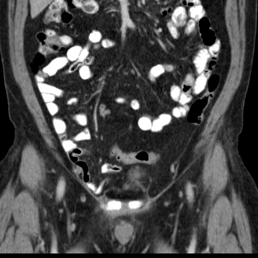 File:Bilateral direct inguinal herniae (Radiopaedia 17016-16719 A 11).jpg