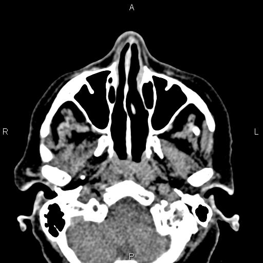Bilateral enlargement of lacrimal glands - sarcoidosis (Radiopaedia 62627-70921 Axial non-contrast 14).jpg