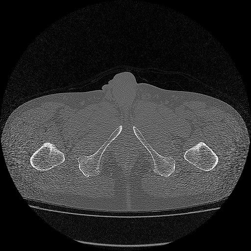 Bilateral femoral neck stress fractures (Radiopaedia 28666-28954 Axial bone window 81).png
