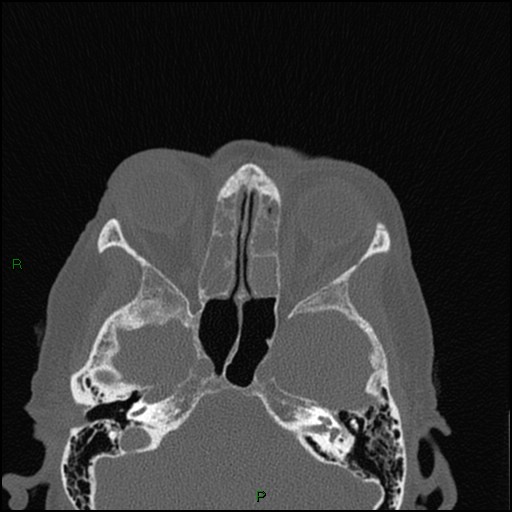 File:Bilateral frontal mucoceles (Radiopaedia 82352-96454 Axial bone window 145).jpg