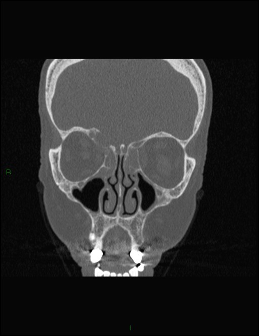 Bilateral frontal mucoceles (Radiopaedia 82352-96454 Coronal 122).jpg