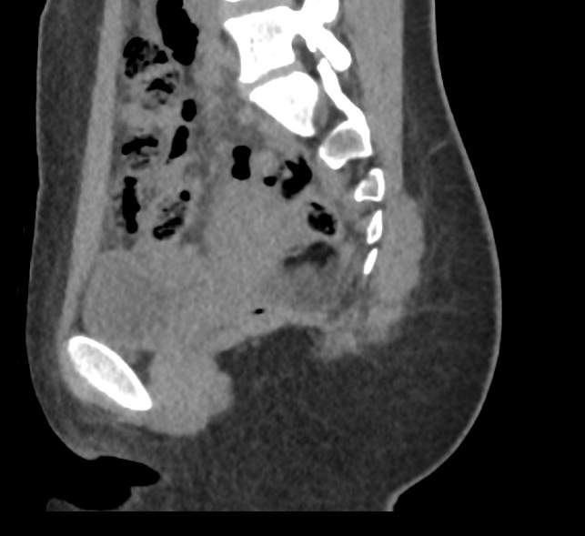 Bilateral mature cystic ovarian teratoma (Radiopaedia 88821-105592 D 24).jpg