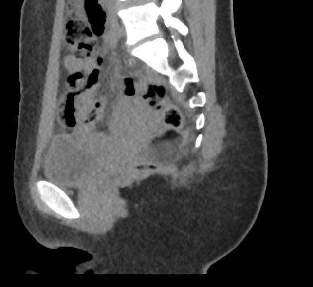Bilateral mature cystic ovarian teratoma (Radiopaedia 88821-105592 D 25).jpg