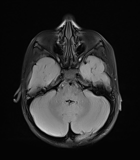 File:Bilateral mesial temporal polymicrogyria (Radiopaedia 76456-88181 Axial FLAIR 6).jpg
