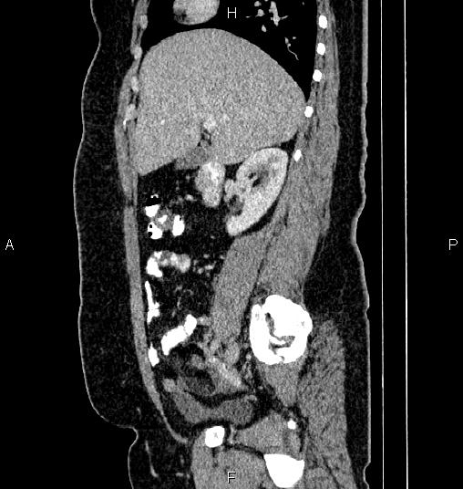 Bilateral ovarian dermoid cysts (Radiopaedia 85785-101603 D 29).jpg