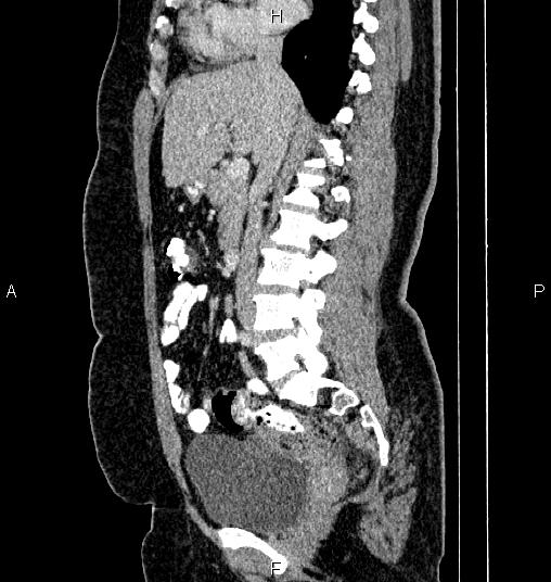 Bilateral ovarian dermoid cysts (Radiopaedia 85785-101603 D 40).jpg