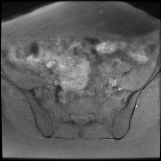 File:Bilateral ovarian fibrothecomas - adolescent (Radiopaedia 86604-102707 Axial T1 fat sat 9).jpg